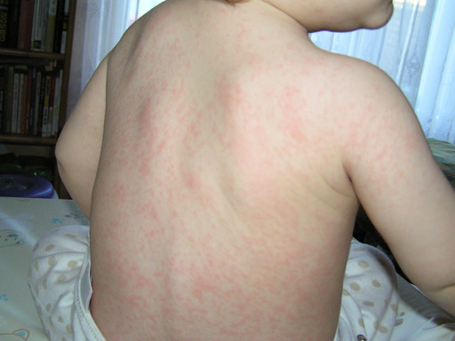 A gyermekkori atópiás dermatitis avagy az ekcéma - Gyógyhírek
